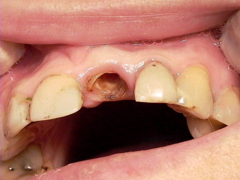 Уход за здоровыми зубами