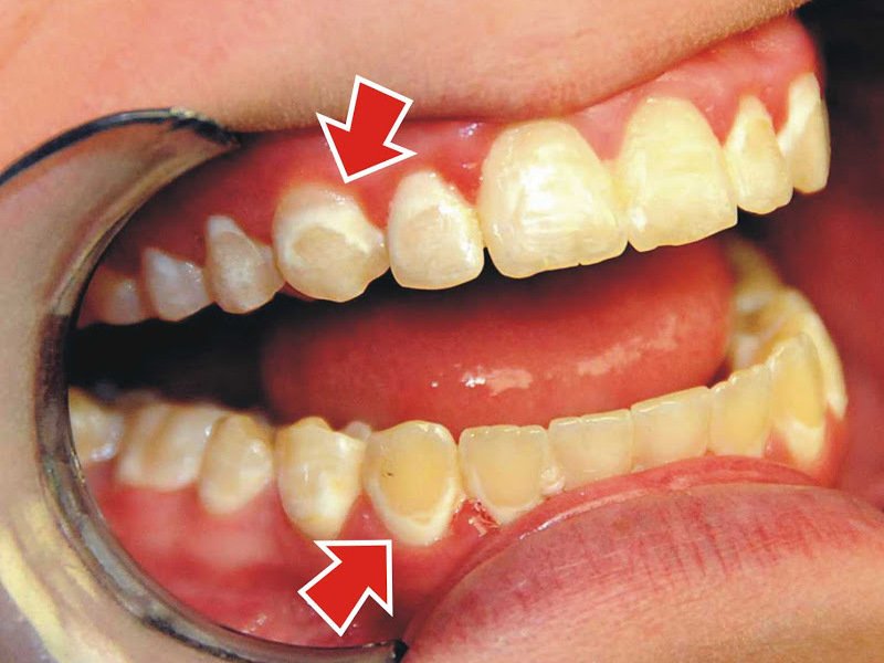 Не лечение зубов, к чему приведет