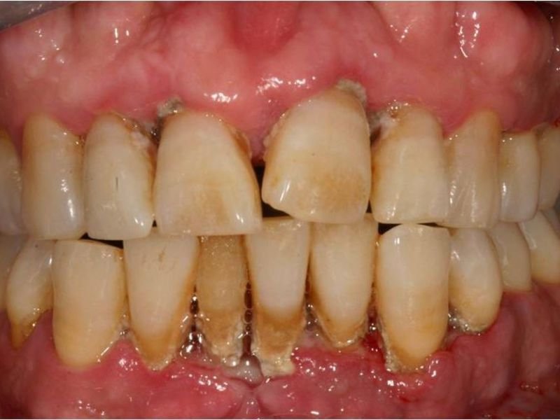 Последствие не лечения зубов вовремя