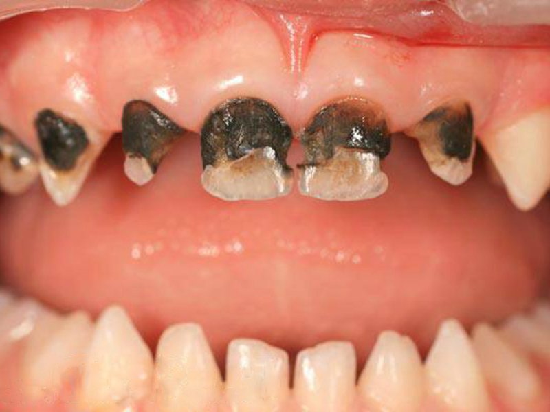 Почему портятся зубы