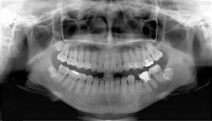 Рентген зубов: что собой представляет панорамный снимок