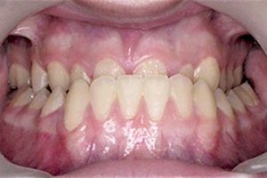 Почему неправильно формируются зубы