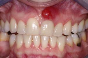 Описание патологии кисты десны зуба