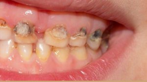 Причины образования кисты на десне зуба