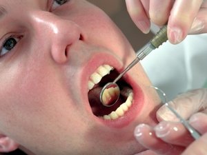 Описание метода стоматологического лечения кисты зуба на начальной стадии
