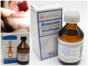 Почему стоит принимать при стоматите Винилин Положительное влияние Винилина при лечении стоматита