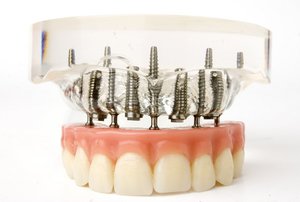 Имплантация передних зубов стоимость 