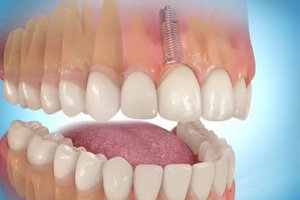 Имплантация передних зубов 