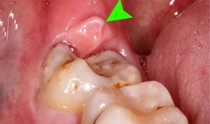 Воспаление десны рядом с больным зубом - фото