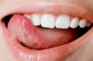 Почему может болеть язык и как его лечат?
