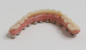 Описание отличий базальных и классических имплантов зубов