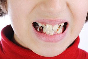 Показания к базальному методу имплантации зубов