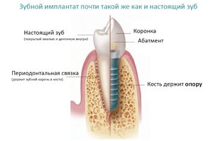 Имплантация зубов: показания, импланты Osstem, отзывы пациентов
