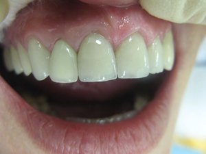 Зубное протезировани