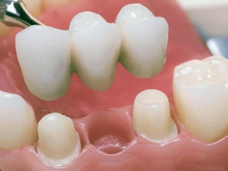 Металлокерамические зубы