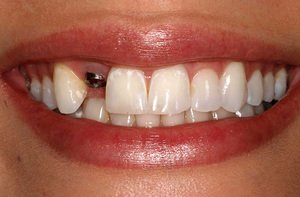 Когда противопоказано протезирование зубов