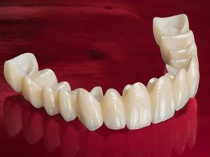 Зубные протезы и их виды