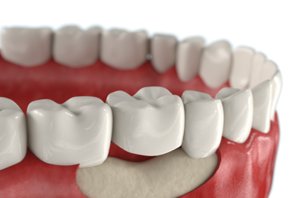 Имплантация зубов при атрофии костной ткани: цены на наращивание