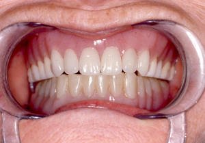 Зубные протезы Акри Фри: отзывы пациентов и рекомендации стоматологов