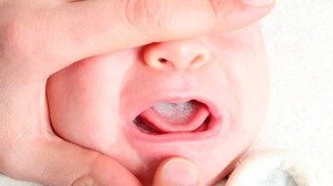 Чем лечить молочницу на языке у грудничка?