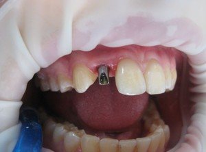 Описание принципа имплантации зубов