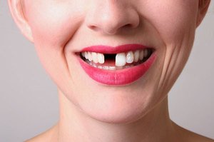 Показания для имплантации зубов