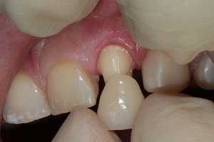 Описание свойств зубных коронок