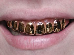 Виды и особенности зубных коронок