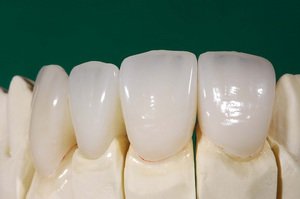 Описание качеств керамических коронок для зубов