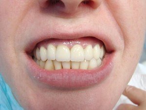 Выбор зубных коронок на импланты