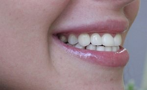 Советы стоматологов, какие коронки лучше