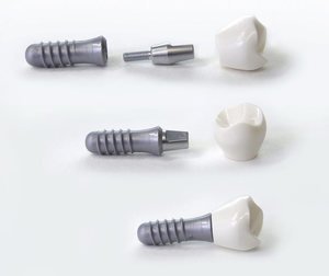 Преимущества титана для изготовления имплантов зубов