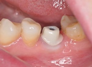Применение абатментов в имплантации зубов