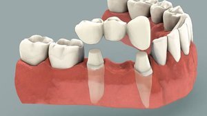 Протез зуба - примеры изделий стоматологов-ортопедов.