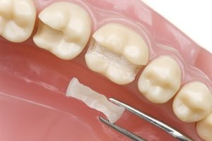 Микропротезирование позволяет восстановить кусок зуба.
