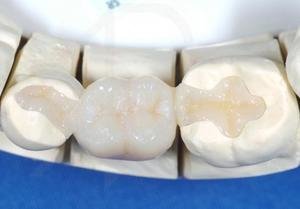 Восстановление зубов методами современной ортопедической стоматологии