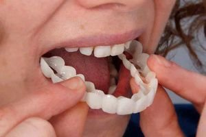 Протезирование зубов на винирах