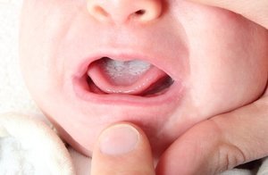 Молочница у ребенка во рту: симптомы, лечение и фото