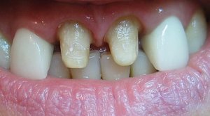 Поврежденные зубы под коронками - популярное решение
