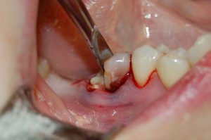 После удаления зубов могут быть назначены антибиотики