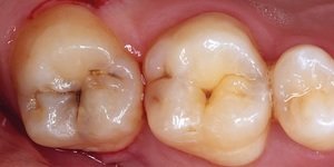 Описание жевательных зубов и клыков человека