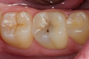 Описание зубов моляров человека