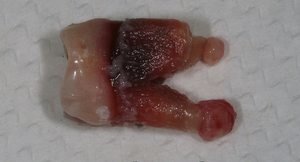 Зуб с кистой - фото больного зуба