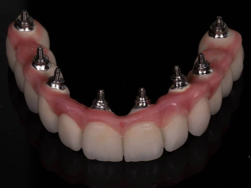 Описание несъёмных зубных протезов