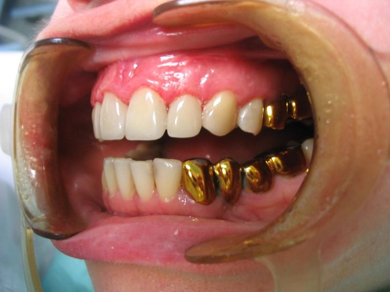 Описание мостовидных протезов зубов