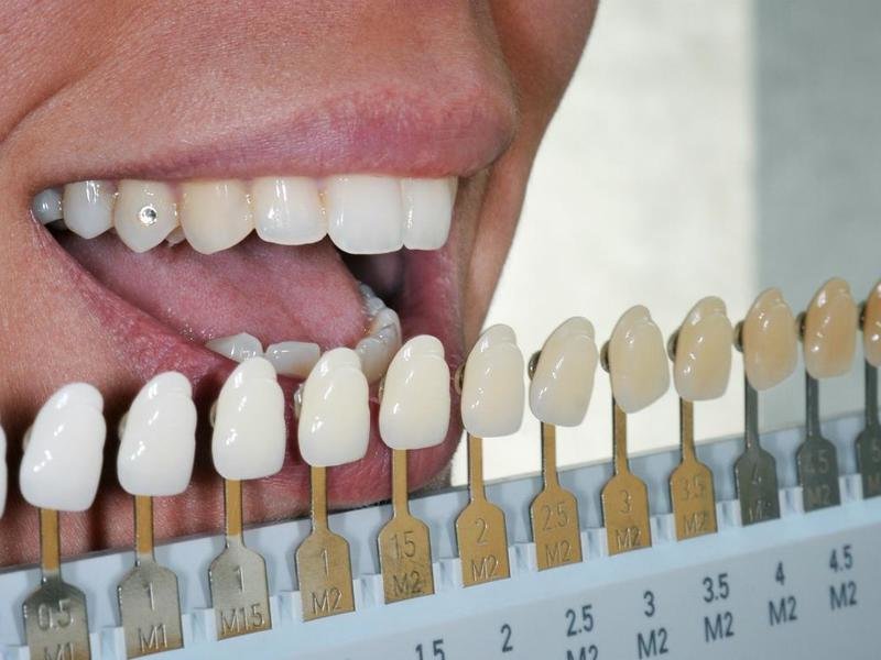 Метод применения виниров в протезировании зубов