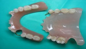 Разновидности съёмных зубных протезов