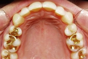 Особенности микропротезирования зубов