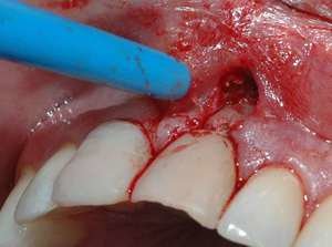 Киста зуба - заболевания стоматологические 