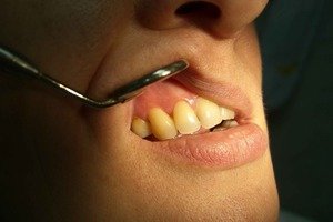 Лечение кисты зуба должен проводить профессиональный врач